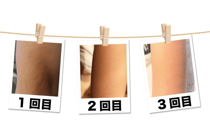 キッズ（子供）脱毛についての外観